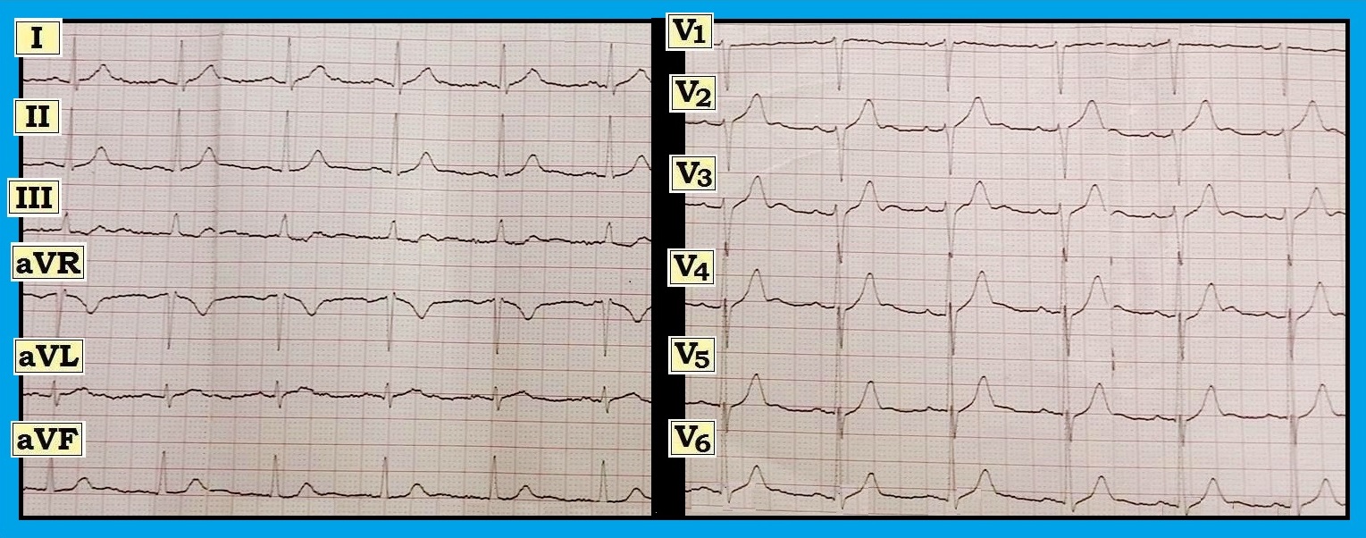 ECG Interpretation: ECG BLOG #115 (Early Repolarization — Peaked T ...