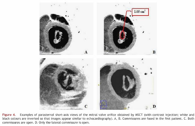parasternal views of mitral valve orifice by MSCT Mitral Stenosis