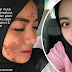 'Inilah gambar muka saya semasa breakout, tapi dah pulih selepas jalani rawatan RM300'