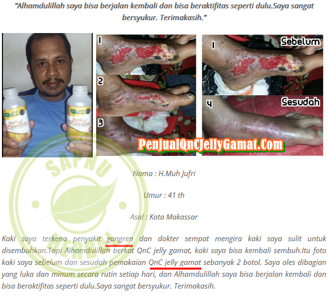 Cara Mengobati Luka Diabetes Basah Secara Alami Terbukti Mujarab ~ Testimoni QNC JELLY GAMAT Cara Mengobati Luka Diabetes Basah Secara Alami Terbukti Mujarab ~ Testimoni QNC JELLY GAMAT