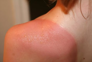painful sunburn blisters