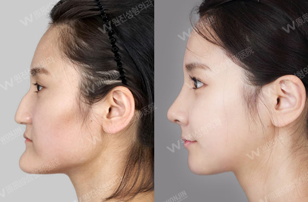 long nose surgery you may look older because of your long nose