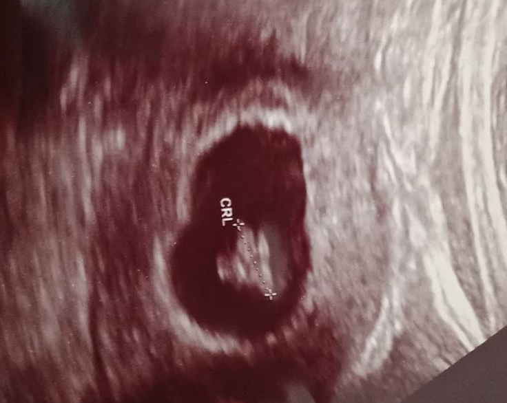 Gebelik Görüntüsü