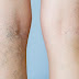 Lifestyle Changes To Help You Deal With Varicose Veins