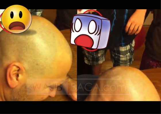 Awalnya Hanya Gatal, Setelah Dicabut Ternyata Benda Ini Bersarang Di Kepala Plontos Pria Ini! Awalnya Hanya Gatal, Setelah Dicabut Ternyata Benda Ini Bersarang Di Kepala Plontos Pria Ini!