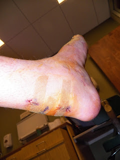 heel cord incision, steri strips, foot surgery