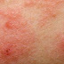 Eczéma et alimentation : démangeaisons, desquamation