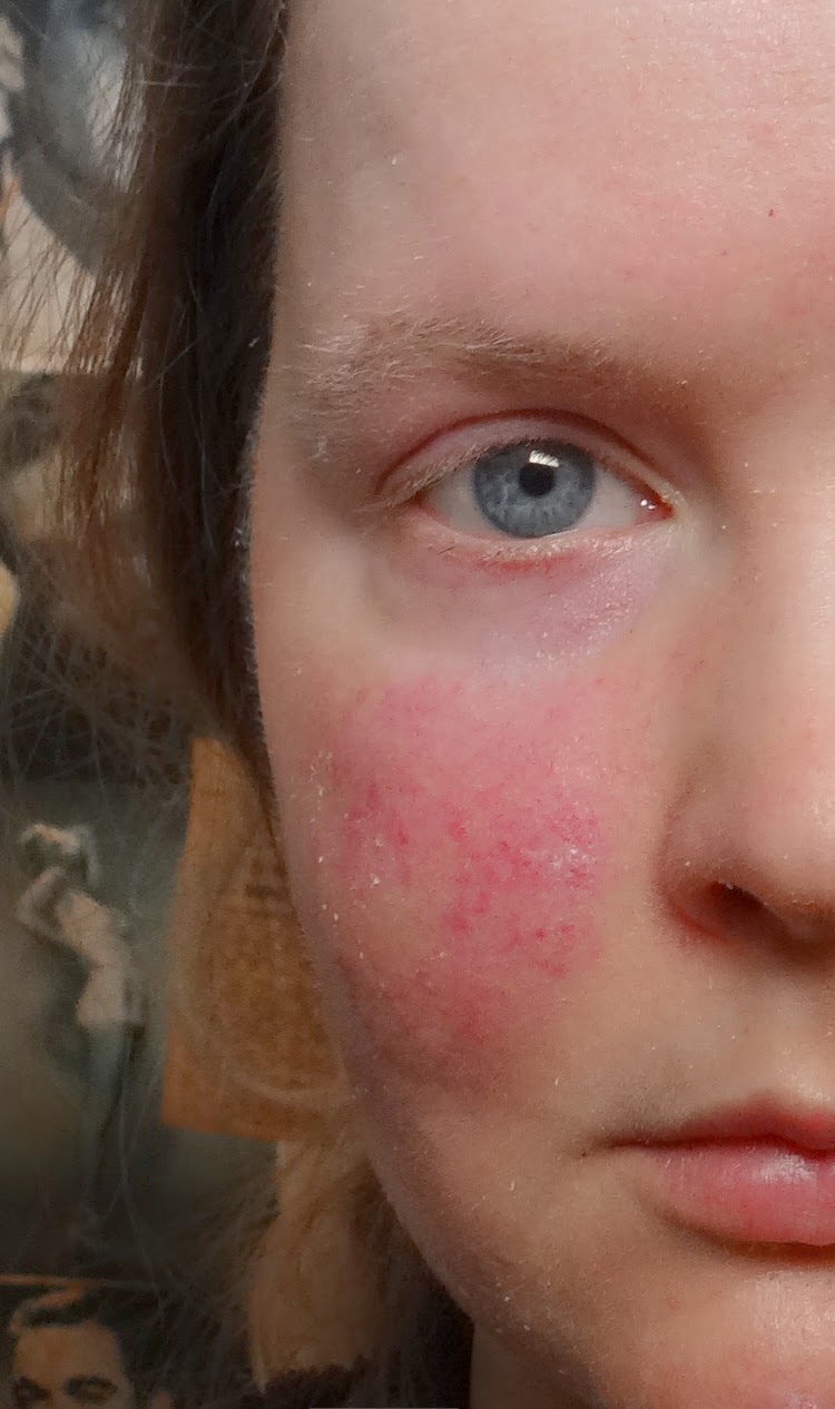 Scarlet Letters, dealing with vascular rosacea, face flushing, burning