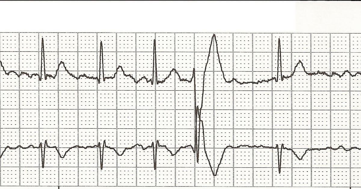 Float Nurse EKG Rhythm Strips 57