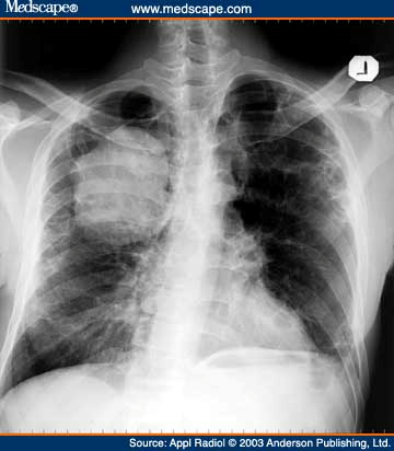 SEKILAS TENTANG FOTO THORAX ~ CATATAN RADIOGRAFER