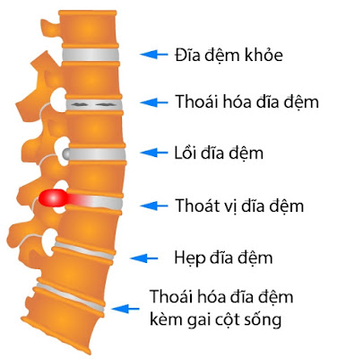 Thoát vị đĩa đệm có gây vô sinh không?