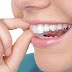  Niềng răng không nhổ răng là gì?