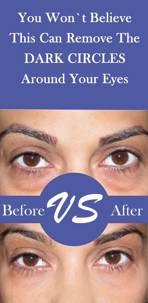 Remove The Dark Circles Around The Eyes With COFFEE !!! HEALTH RECIPES