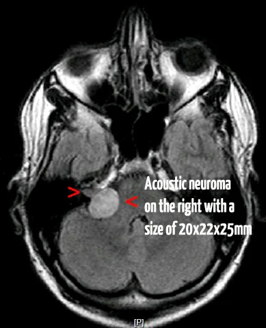 small tumor of acoustic neuroma