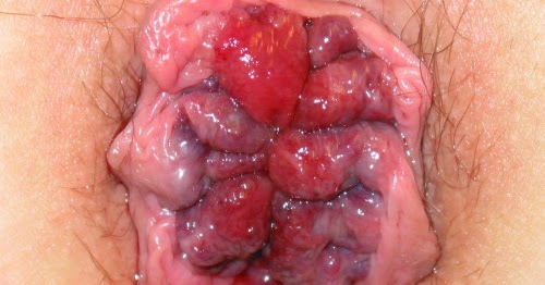 Hemorrhoids help Are you bothered by your hemorrhoids? There is no need to ask since hemorrhoids are really one of the most unsettling conditions of all. Fortunately, there is Preparation H to help you get away from the pain, itching, burning, swelling and even bleeding brought hemorrhoids.. Preparation H is a most popular and world’s best selling hemorrhoids treatments brand of medications since