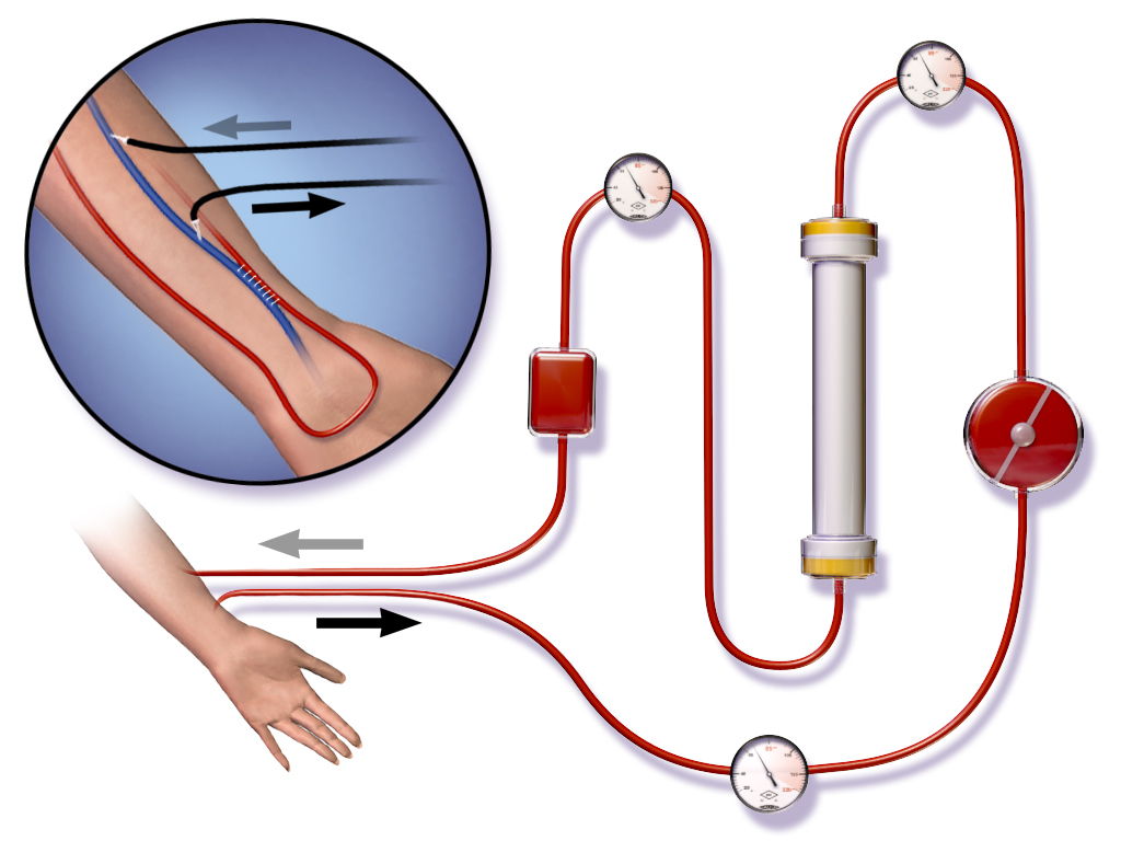 hemodialysis chronic kidney disease and healthy hemodialysis chronic kidney disease and healthy