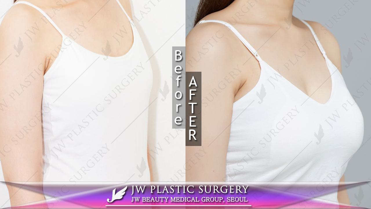 маммопластика симферополь. маммопластика симферополь. маммопластика симферополь. аффирмации на увеличение груди. маммопластика уменьшение груди до и после.