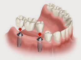 Τι είναι η οδοντιατρική γέφυρα και τι πρέπει να προσέχουμε; Image3