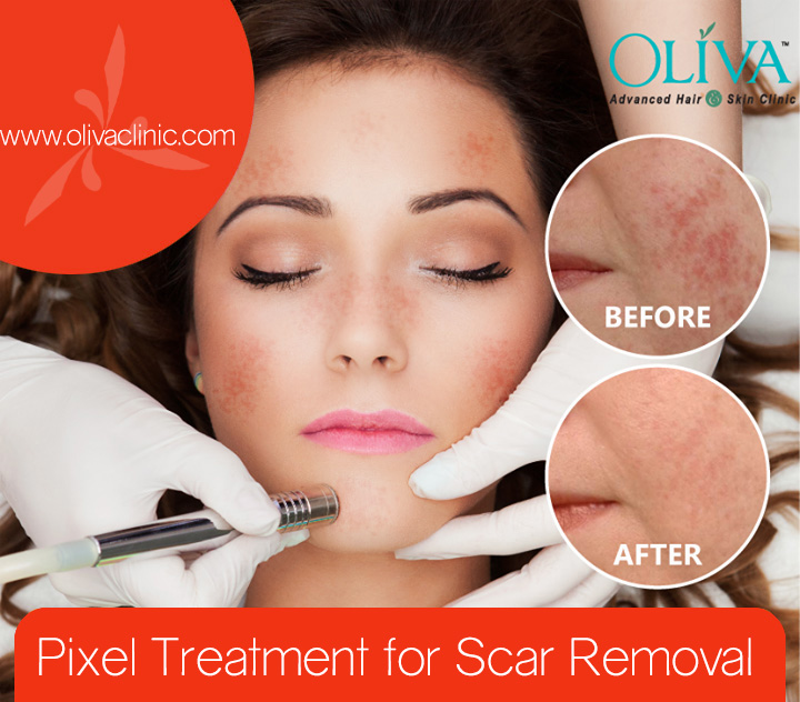 Scar Removal with Pixel Laser Resurfacing in Bangalore Oliva Clinic