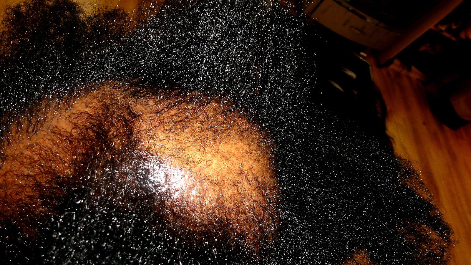 Head lice infestation American American Choices