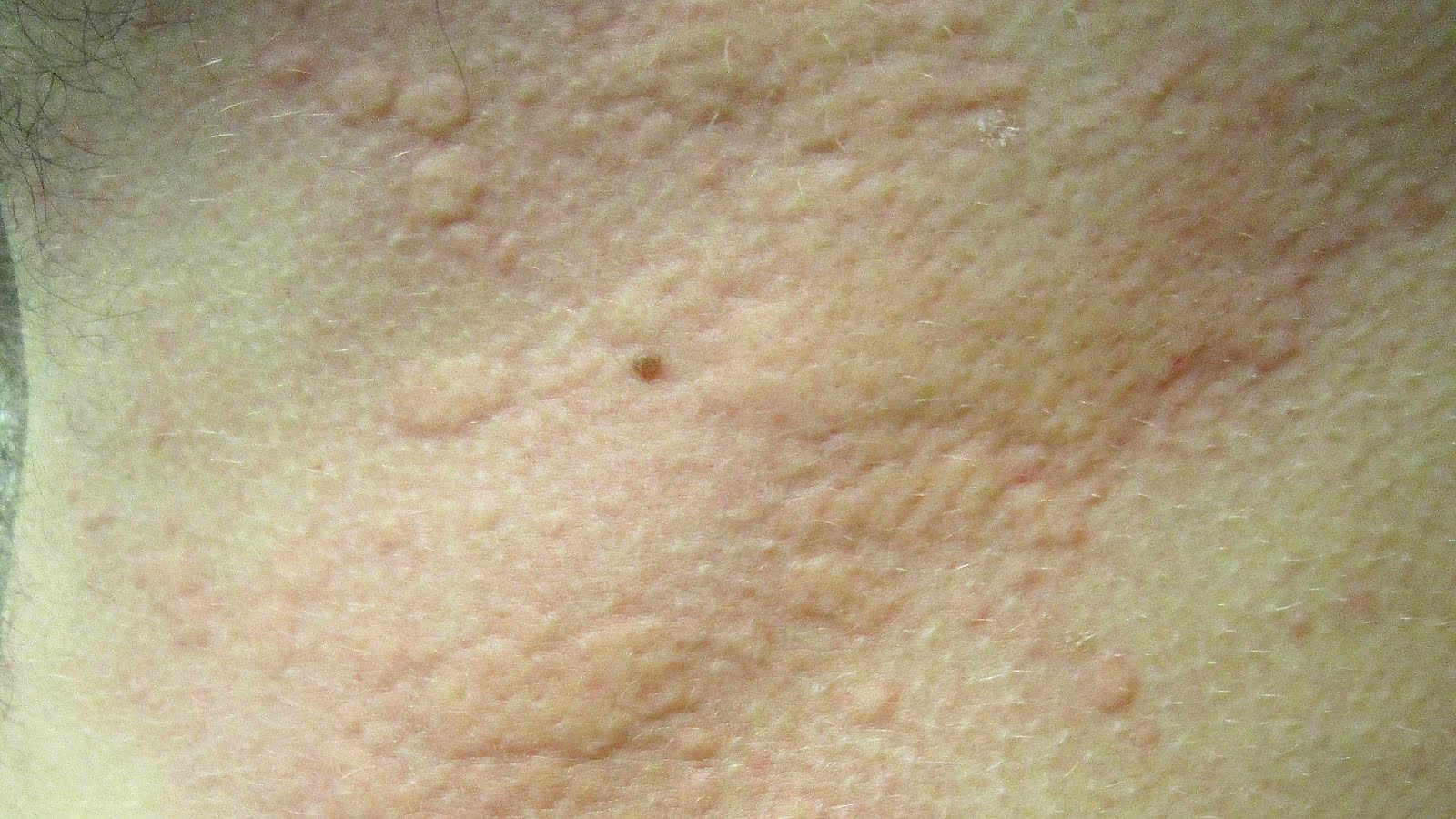 Symptoms Of Fish Allergy In Adults Fish Choices