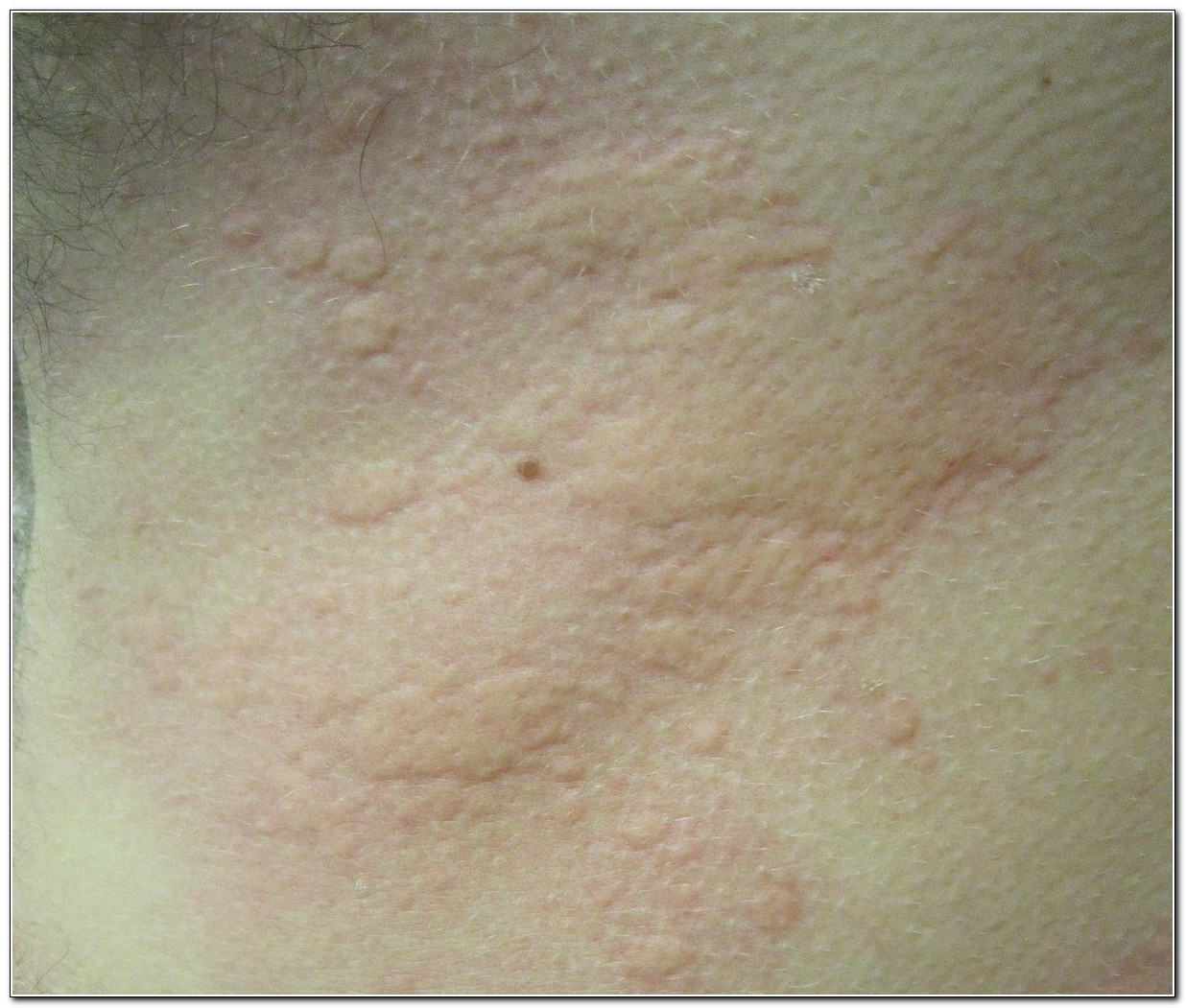 Some Pictures Of Laundry Detergent Rashes ALL AROUND LAUNDRY