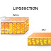 สิ่งที่เกิดขึ้นในระหว่างขั้นตอนการ SmartLipo?