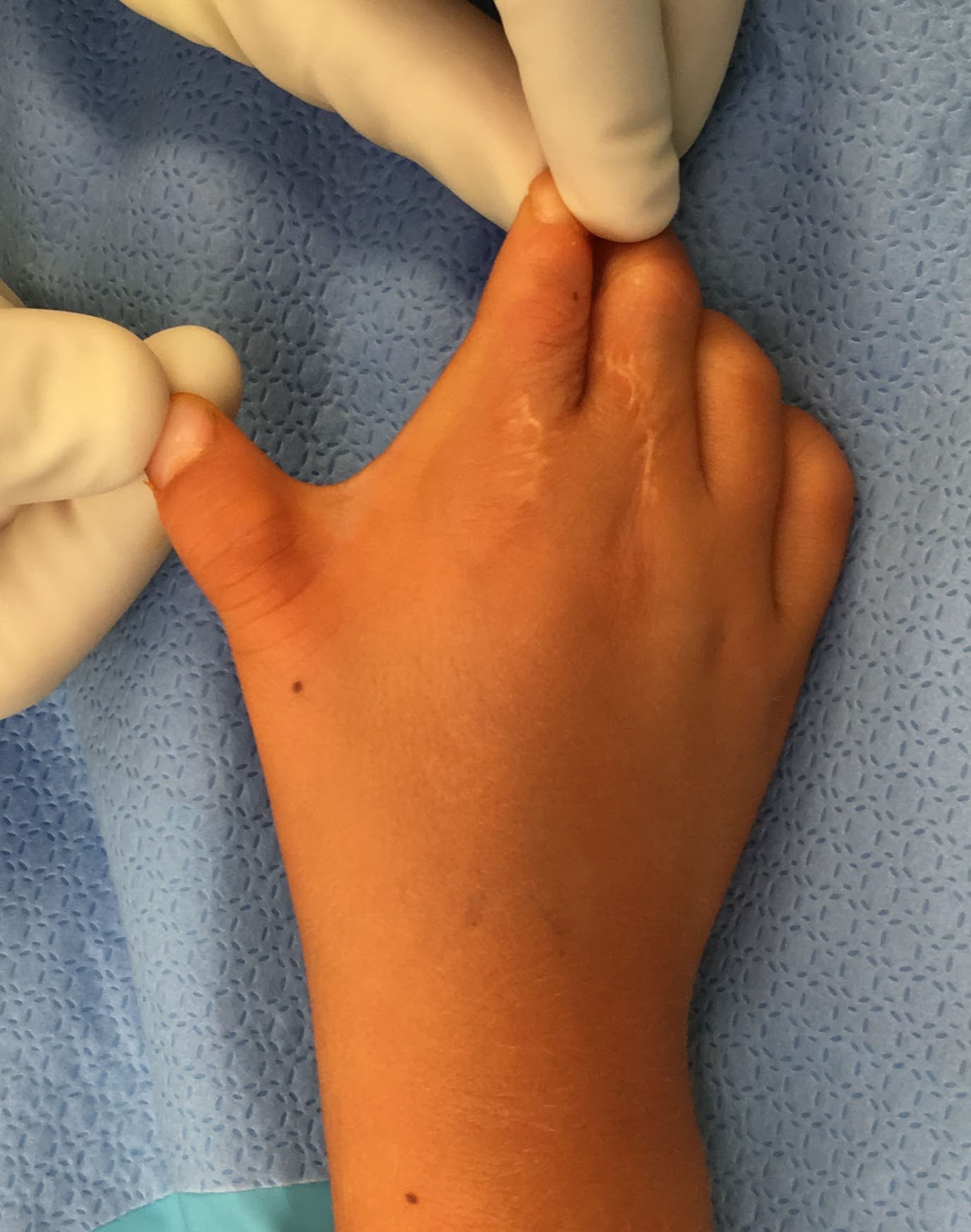 Skin Contracture and Zplasty Correction Congenital Hand and Arm