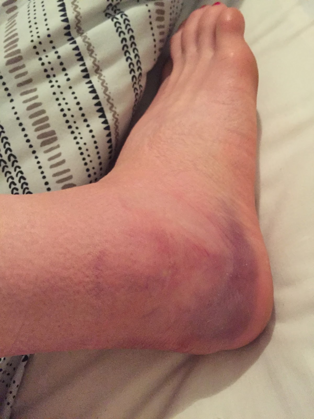 Dealing with a severe ankle sprain Performance Sports Therapy