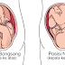 My Baby Breech