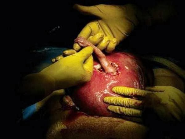 A 21-week fetus hand reaching up through an incision ...