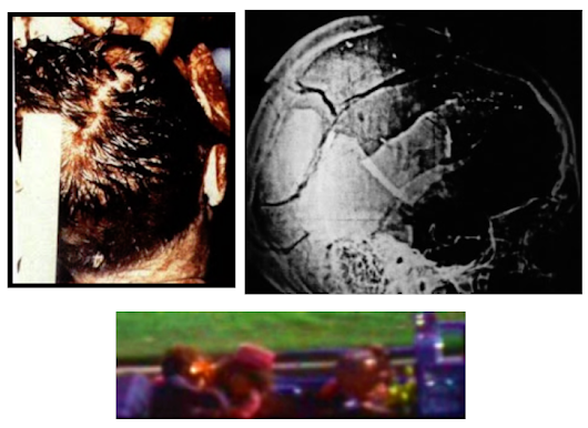 JFK-Head-Wound-Photographic-Comparison.png