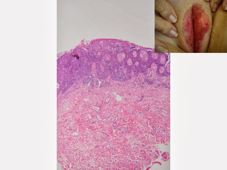 Dermpath Made Simple Neoplastic Other Malignant Epidermal Tumours