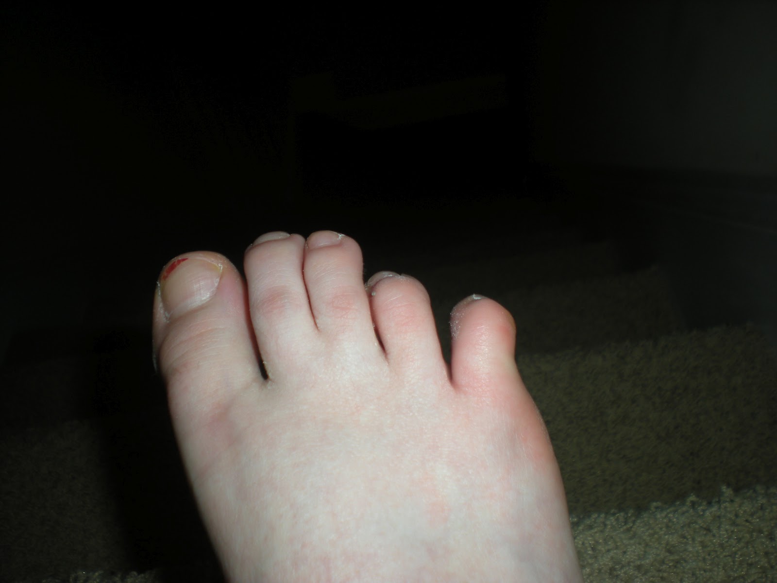 Driggers Diggs Broken toe