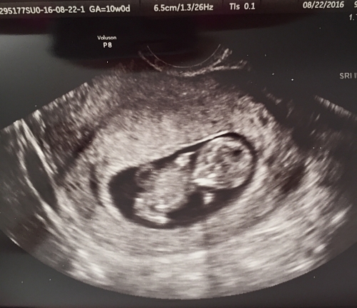 ultrasound photo of Luke