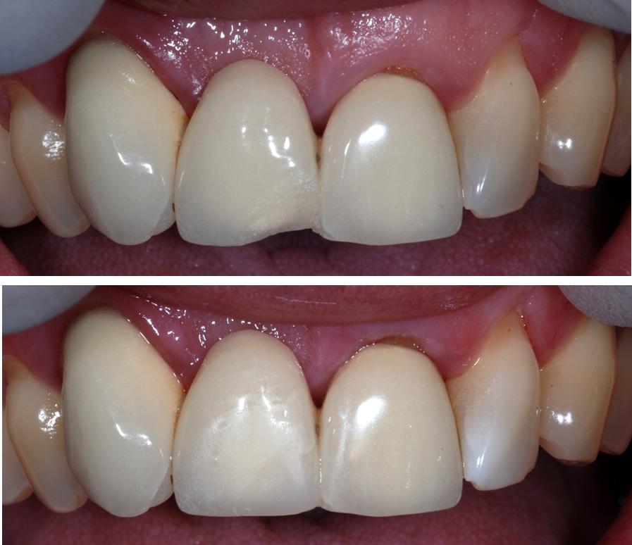 VIDEOCONFERENCING ABC's of Ceramic Bonding and Repair Dr. Marc Gottlieb