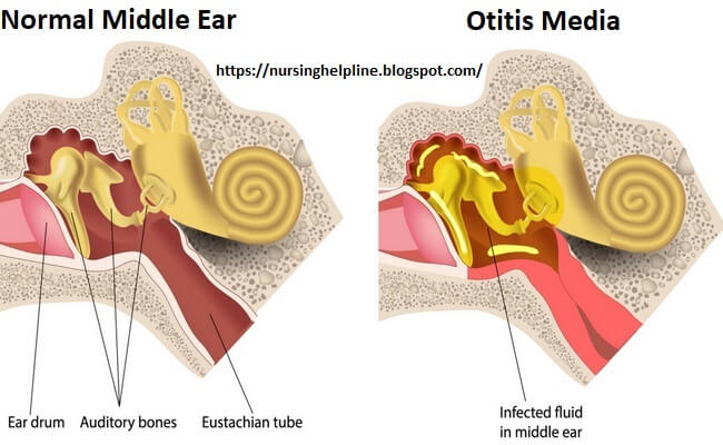 Otitis Media Symptoms Otitis Media Complications Otitis Media