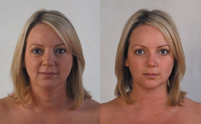 Facial Exercises Produce Natural Facelifts For Men And Women