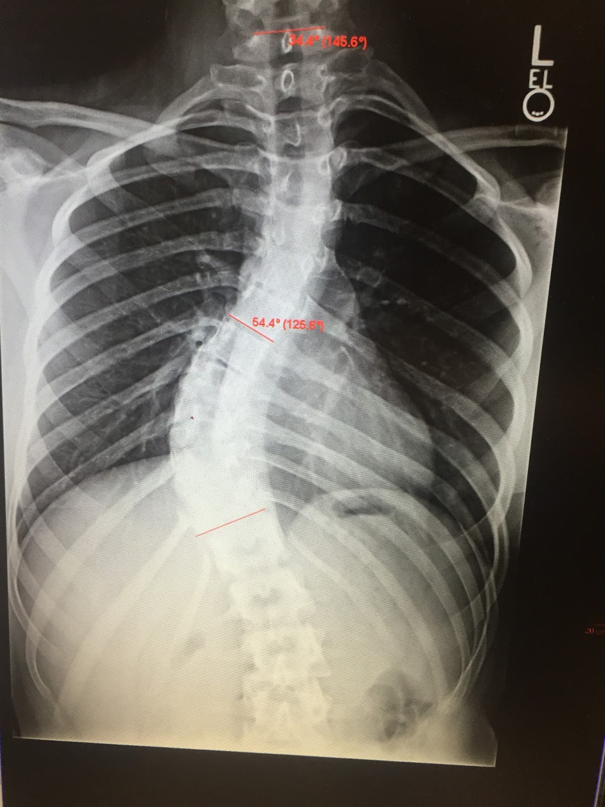 pediatric-orthopedics-studying-complications-following-spinal-fusion