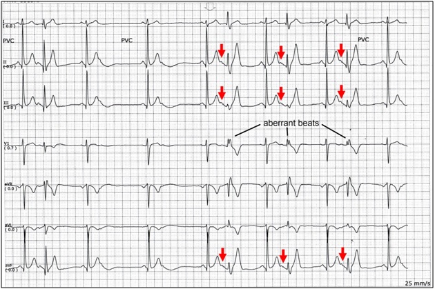 ECG Rhythms Aberrancy ecg-rhythms-aberrancy