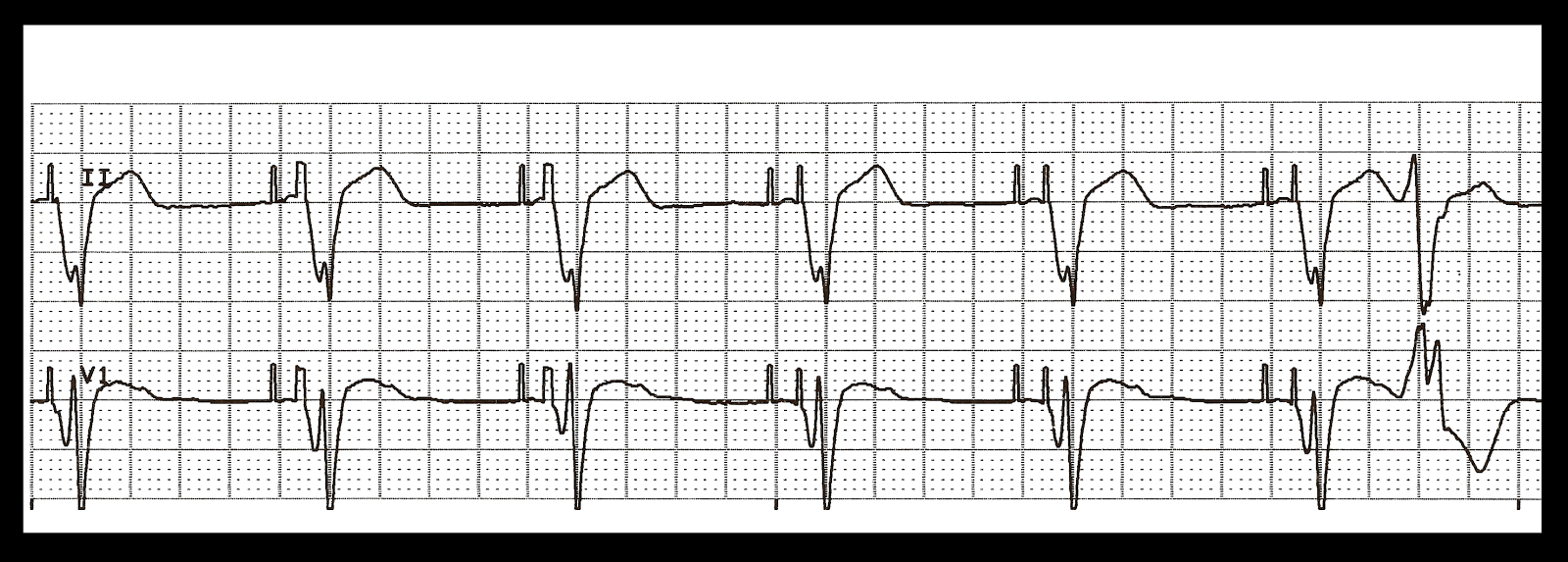 Practice EKG Strips 380