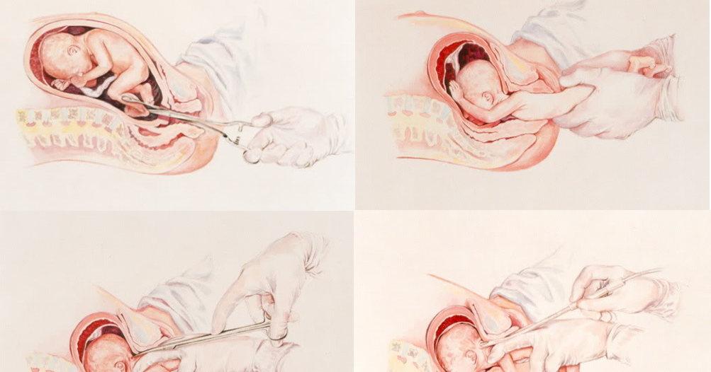 Bioetica Y Vida Humana 182 Bebes Nacen Vivos Tras Aborto