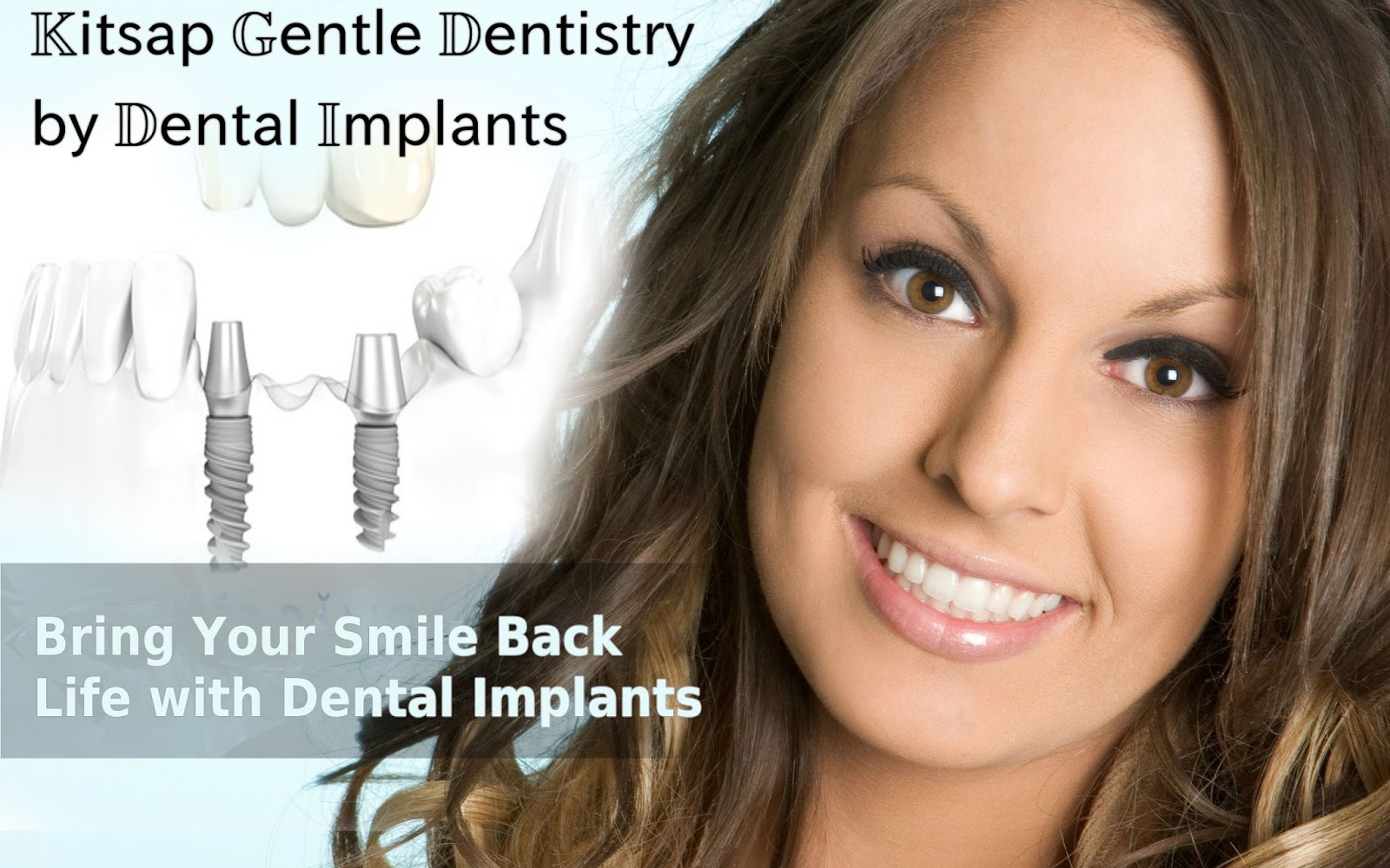 Kitsap Gentle Dentistry Dental Implants Silverdale