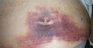 Hematoma