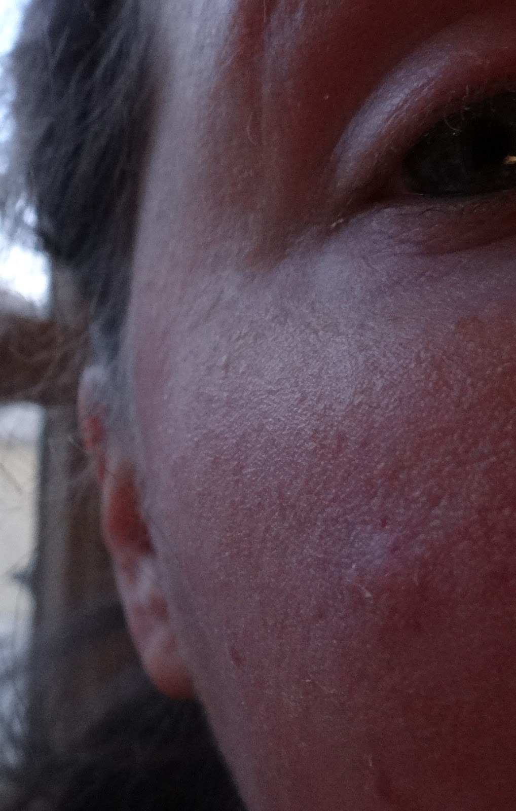 Scarlet Letters, dealing with vascular rosacea, face flushing, burning