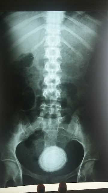 A large stone in urinary bladder, courtesy of Dr. Adil Ramzan