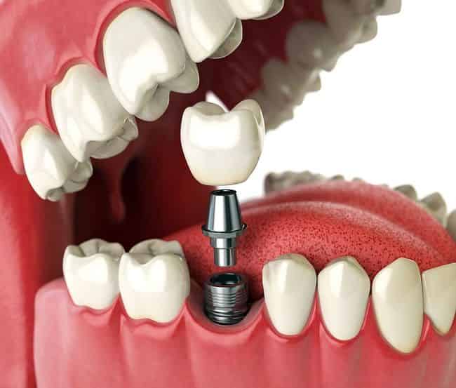 Implante Dentario
