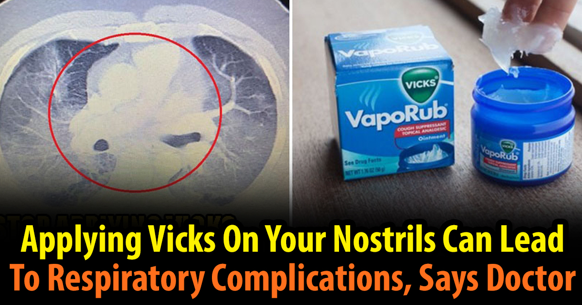 Applying Vicks On Your Nostrils Can Lead To Respiratory Complications