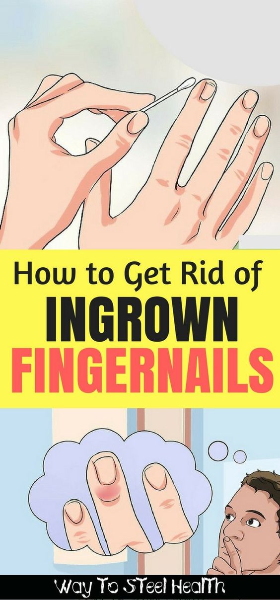 How to Get Rid of Ingrown Fingernails healthymasters