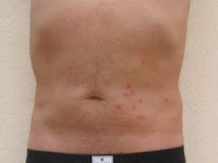 Comment faire disparaître les punaises ?